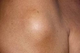 lipoma