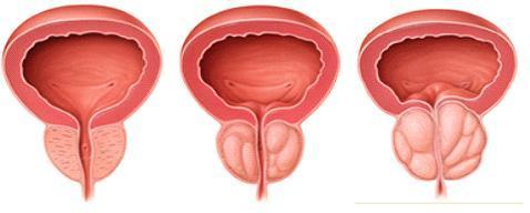 prostatis ypeplasia1