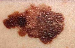 melanoma