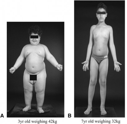 Leptin therapeia