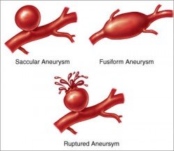 aneurysmata