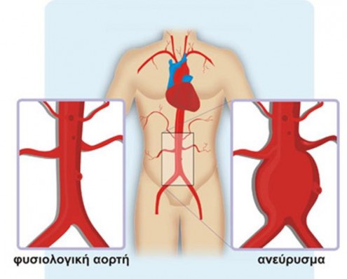 aneyrysma