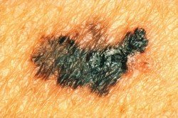 melanoma gonidia