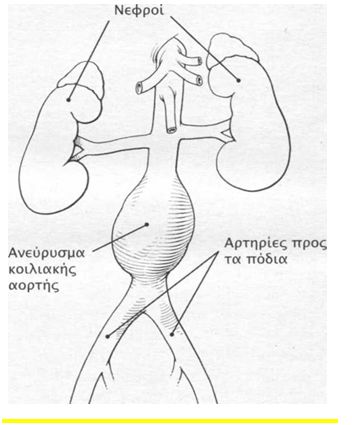aneurysma
