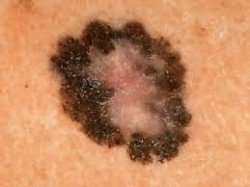 melanoma skin karkinos