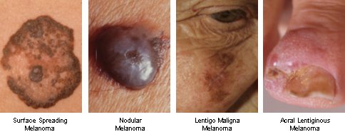 melanoma types