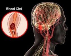 egkefaliko 4 clot