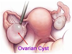 ovarian-cyst 4 4