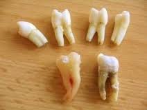 periodontitis arxaioi 4