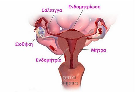 endomitriosis 55