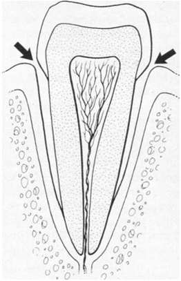 periodontitida5