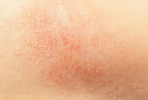 eczema_overview