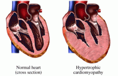 normal_and_hypertrophic_heart