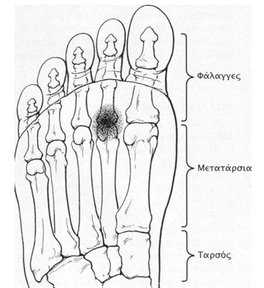 metatarsia 4