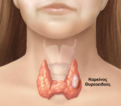 Thyroid karkinos