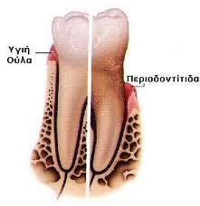periodontitida