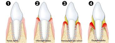 periodontitis