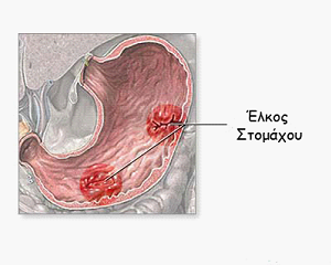 elkos stomaxou