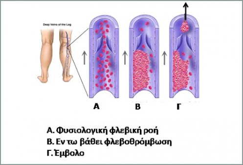 flevothromvosi