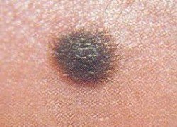 melanoma therapeia