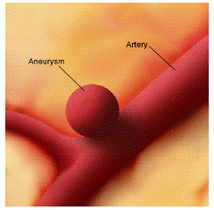 aneurysisma xoris rhxh