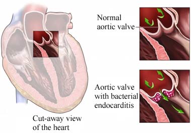 endokarditida3