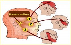 Neuralgia tridhmou