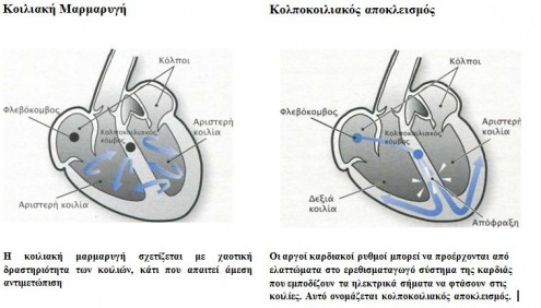 arrythmies typoi2