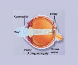 astigmatismos