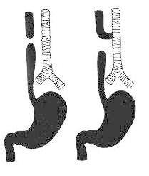 esophageal_atresia