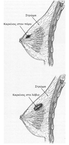 karkinos stithos 4