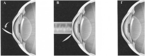 lasik