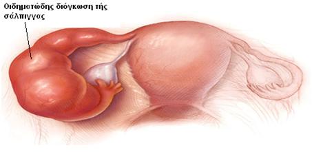 pelvis-flegmonh