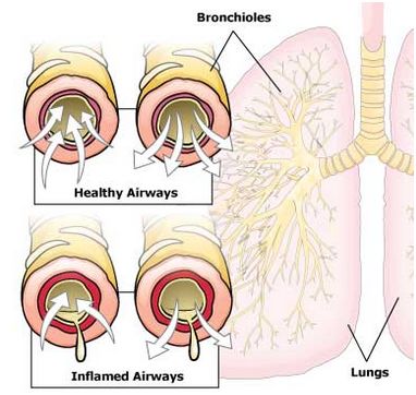 vrogxiolitis