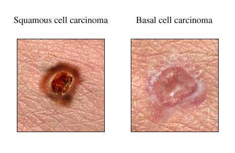 Squamous-VS-Basal-