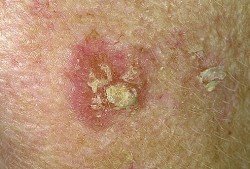 actinic_keratosis