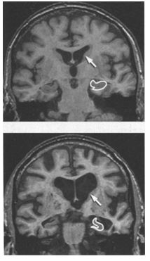 alzheimer1_2