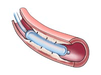angioplasty 1