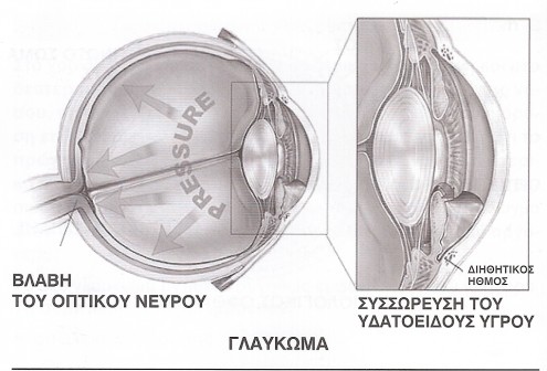 glaucoma 44