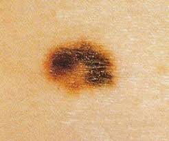 melanoma 4