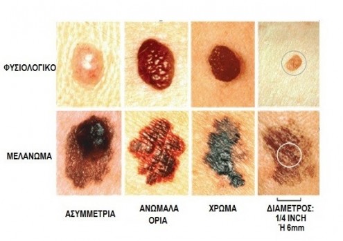 melanoma