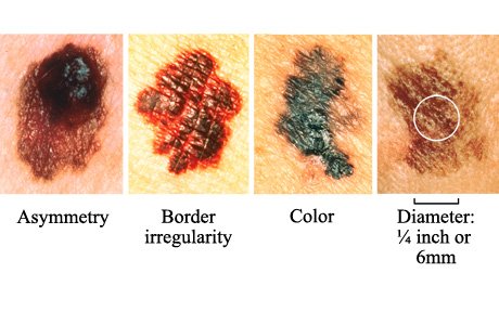 melanoma abcd