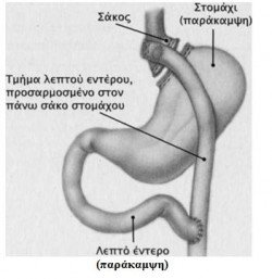 stomaxi parakampsi