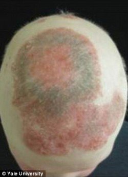 alopekeia yale1