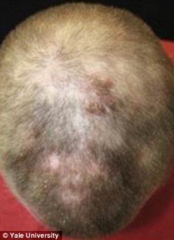 alopekeia yale2