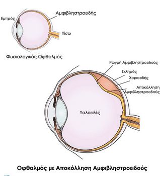 apokollhsh retinas