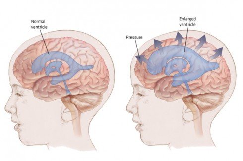hydrocephalus