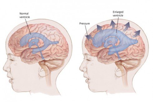 hydrocephalus