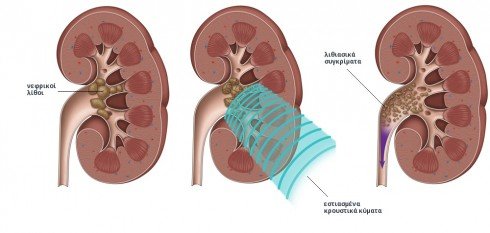 lithotripsia