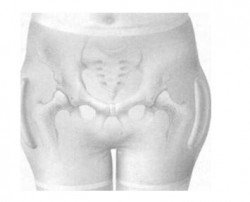 meso prostasias isxiou